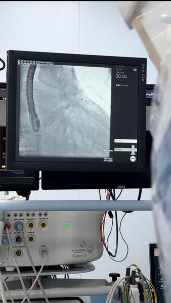 В АЛМАТЫ УСПЕШНО ПРОВЕДЕНА ОПЕРАЦИЯ ПО ИМПЛАНТАЦИИ ОККЛЮДЕРА УШКА ЛЕВОГО ПРЕДСЕРДИЯ