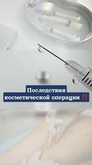 Последствия косметической операции