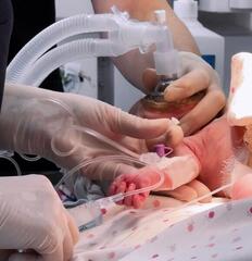 Карагандинские врачи прооперировали новорождённого с тяжёлым пороком