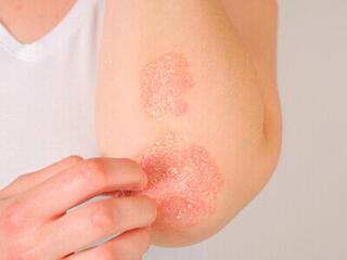 Профилактика дерматофитии!