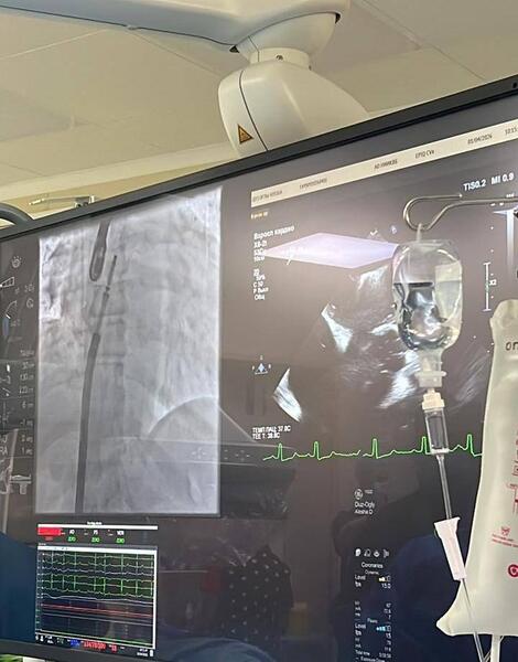 В НИИ КАРДИОЛОГИИ И ВНУТРЕННИХ БОЛЕЗНЕЙ ПРОВЕДЕНЫ УНИКАЛЬНЫЕ ОПЕРАЦИИ ПО ТЕХНОЛОГИИ TEER